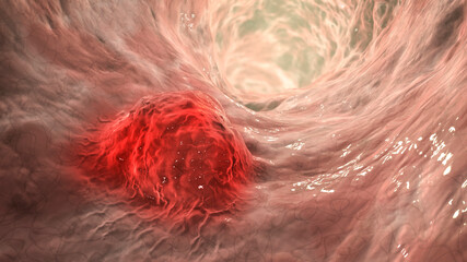 Intestinal carcinoma, colorectal cancer, bowel neoplasia, 3D illustration