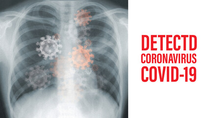Coronavirus Covid-19 X-ray film.