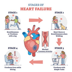 Stages of heart failure and symptoms with cardiology stroke outline diagram. Educational labeled guide with medical problem symptoms and cardiac arrhythmia or attack recognition vector illustration.