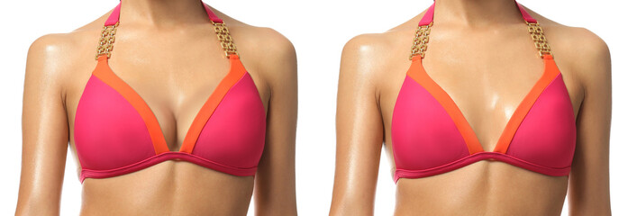 Collage with photos of young woman before and after breast size correction on white background,...