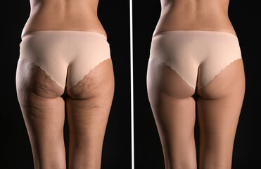 Collage with photos of woman before and after anti cellulite treatment on black background, - obrazy, fototapety, plakaty