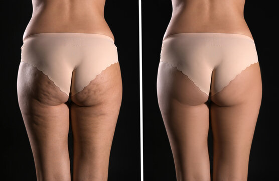 Collage with photos of woman before and after anti cellulite treatment on black background,