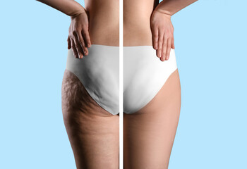 Collage with photos of woman before and after anti cellulite treatment on light blue background,