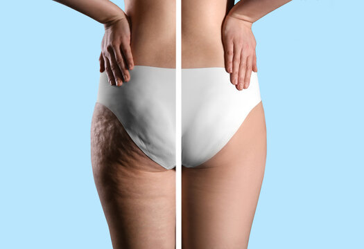 Collage with photos of woman before and after anti cellulite treatment on light blue background,