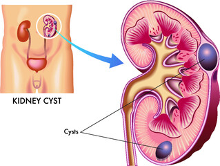 Medical illustration of a kidney with some cysts.