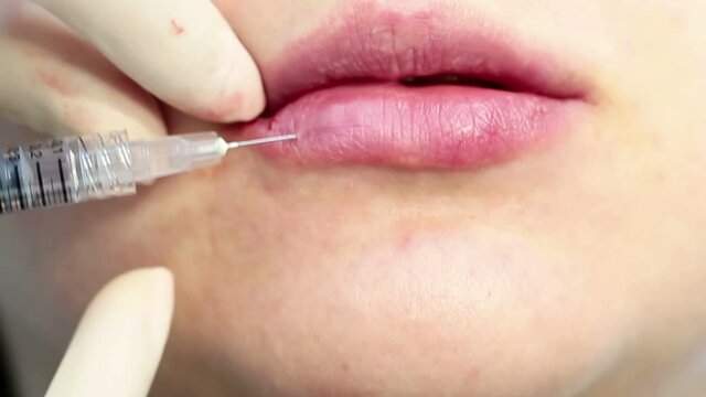 Lip augmentation hyaluronic acid filler injection real procedure in a professional cosmetology clinic. bottom lip. Video footage. Woman having lips plastic surgery operation. doctor in medical sterile