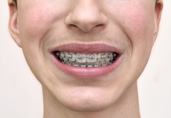 Teenage boy with braces on his teeth. Close-up.