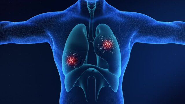 Lungs Cancer and chest infection Visualization, It can be used in medical projects, documentaries, etc. 