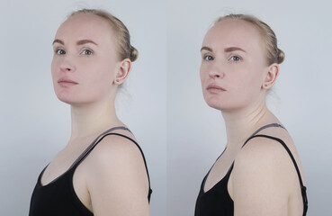 Before and after kyphosis. The woman suffers from a curvature of the spine in the upper section....