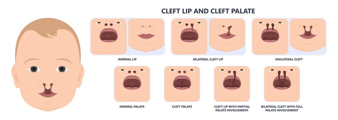 Cleft lip birth defect baby face nose Born gene drink bifid uvula roof Oral
