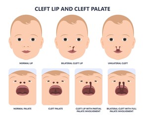 Cleft lip birth defect baby face nose Born gene drink bifid uvula roof Oral