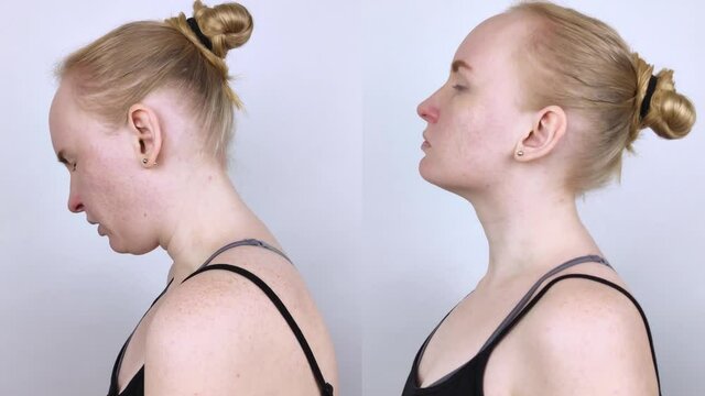 Before and after kyphosis. The woman suffers from a curvature of the spine in the upper section. The cervical vertebrae bulge out and form a hump. Curvature and incorrect posture treatment concept