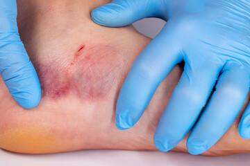 Doctor is examining an injured foot with bruise and scratch. Bruise on womans leg skin