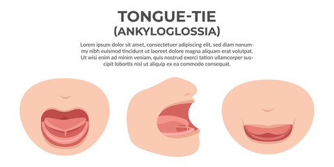 Tongue tie illustration, a health problem find common on new born baby