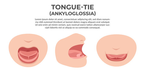 Tongue tie illustration, a health problem find common on new born baby