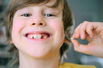 The child's milk tooth fell out. A satisfied boy holds a tooth in his hand. The hole is visible in the gum. Close-up.