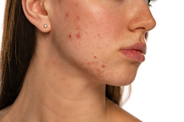 Closeup of a female face with problematic skin