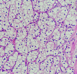 Photo of clear cell renal cell carcinoma, characterized by clear cytoplasm of tumor cell,...