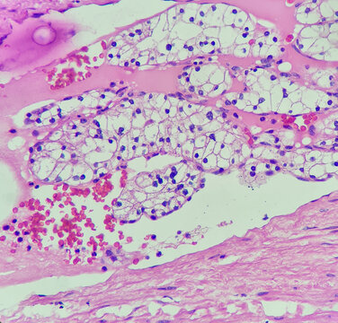 Photo of clear cell renal cell carcinoma with vascular invasion, magnification 400x, photo under microscope