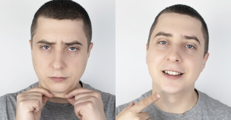 Double chin lift. Before and after plastic surgery, mentoplasty or face-building. Chin fat removal...