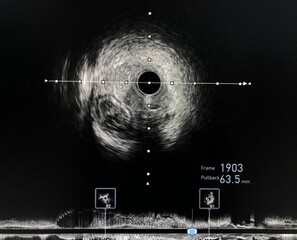 Intravascular ultrasound imaging (IVUS) shown guide wire in a false lumen during percutaneous coronary intervention (PCI) of chronic total occlusion (CTO) coronary artery.