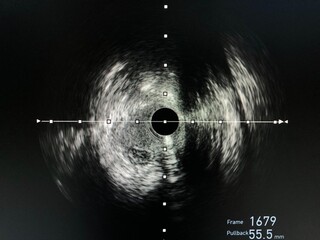 Intravascular ultrasound imaging (IVUS) shown guide wire in a false lumen during percutaneous...