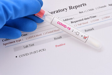 Nasopharyngeal swab positive with COVID-19 test by using RT-PCR method 