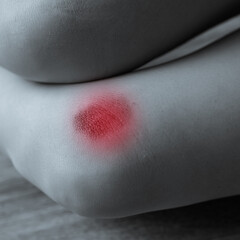 Black and white photo of woman's leg with petechia on skin