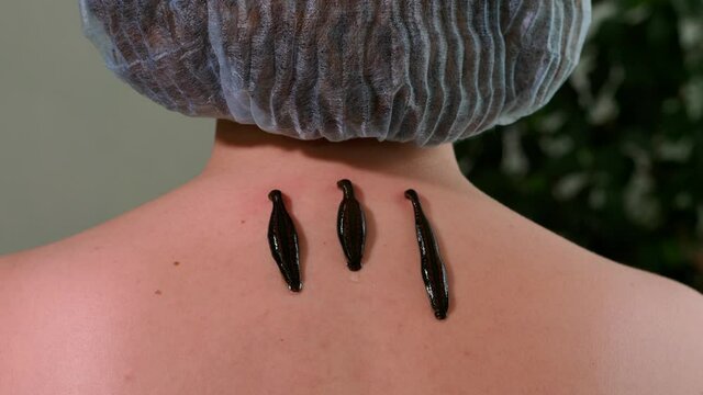Three leeches on patient's neck, close-up. Hirudotheraphy concept. High quality 4k footage