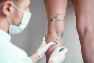 Vein markup. Vascular surgeon is marking veins for varicose surgery