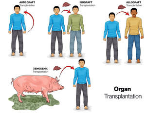 Illustration of Types of organ transplantation in Humans.
