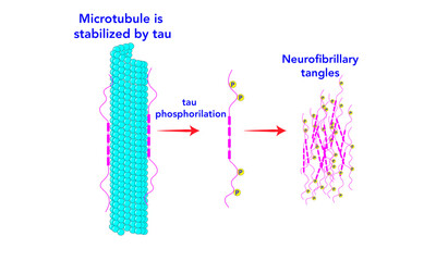 Neurofibrillary tangles [Tau proteins] microtubule