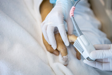 Hand of an asian patient in a severe coma with an attached pulse oximeter on fingertip,nurse...
