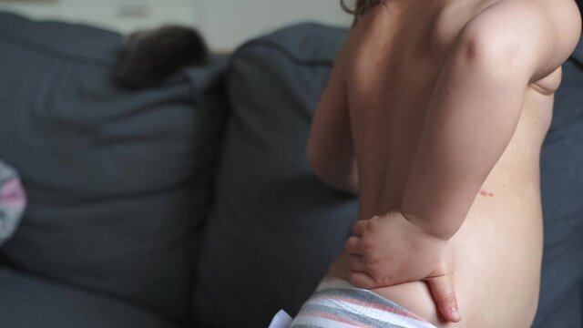 Toddler girl with chickenpox measles on the body. Varicella virus childhood contagious disease. Itchy red blisters, fever, pain symptoms. 