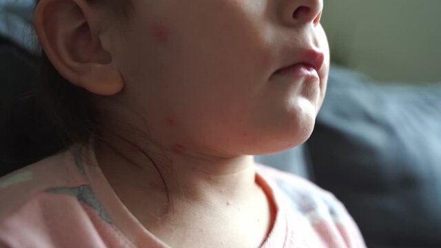 Toddler girl with chickenpox measles on the body. Varicella virus childhood contagious disease. Itchy red blisters, fever, pain symptoms. 