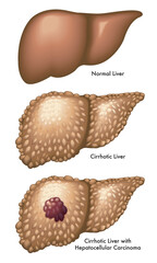 Medical illustration shows the difference between a normal liver, one with cirrhosis and one with cirrhosis and hepatocellular carcinoma, with annotations.