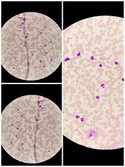 CBC blood film show neutrophilic leucocytosis. Microscopic 100x objective image.Illustration...