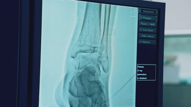 Patient's bones displayed on hospital monitor. Magnetic resonance. Disease diagnostics. Special medical equipment. Computer shows x-ray of inner organs.