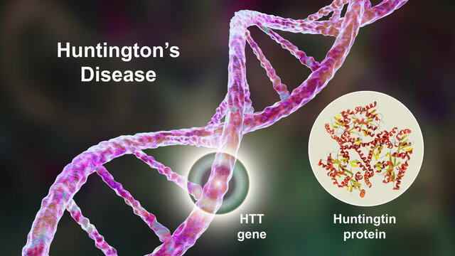 Huntington's disease, a neurodegenerative disease due to mutation in the huntingtin gene, HTT, conceptual 3D illustration