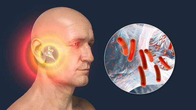 Otitis media, inflammatory disease of the middle ear, 3D illustration