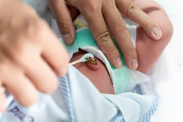 Hand using cotton bud to clean baby Umbilical cord