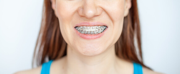 The woman smiles, showing her white teeth with braces. Even teeth from wearing braces. The concept...