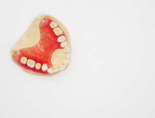 maxillary Removable partial denture