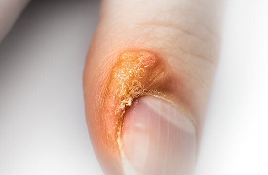 Close up Wart on finger. Contagious skin illness on woman's hand. Medical treatment, macro photo.