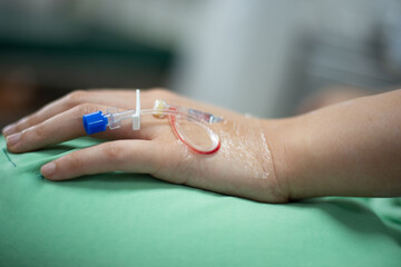 Close up hand of patient on heparin lock in hospital.
