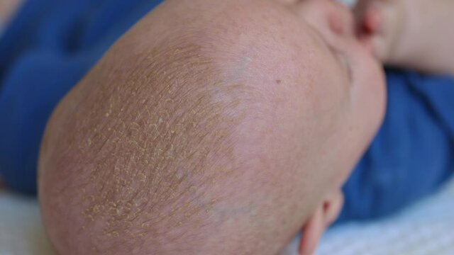 close-up view of seborrhea dermatitis or cradle cap crusts on baby infant sculp 