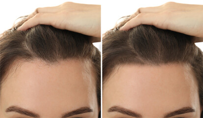 Fototapeta premium Woman suffering from baldness on white background, closeup. Collage with photos before and after treatment