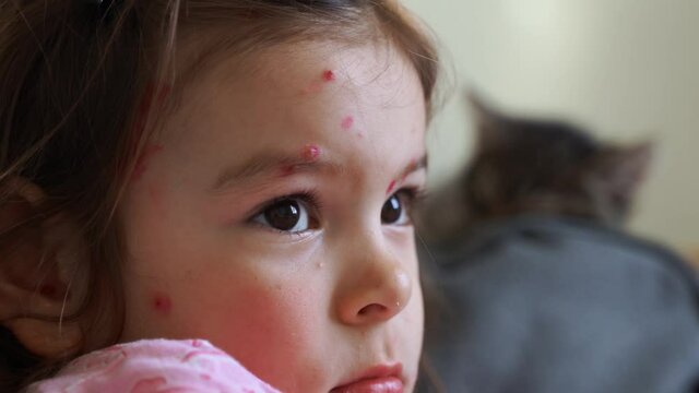 Toddler girl with chickenpox measles on the body. Varicella virus childhood contagious disease. Itchy red blisters, fever, pain symptoms. 