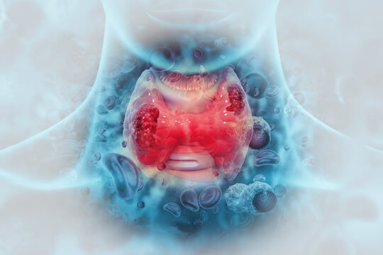 Thyroid gland cancer. showing thyroid gland with tumor. 3d illustration