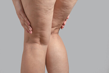 Stretch marks, cellulite and varicose veins on female legs. Copyspace - obrazy, fototapety, plakaty